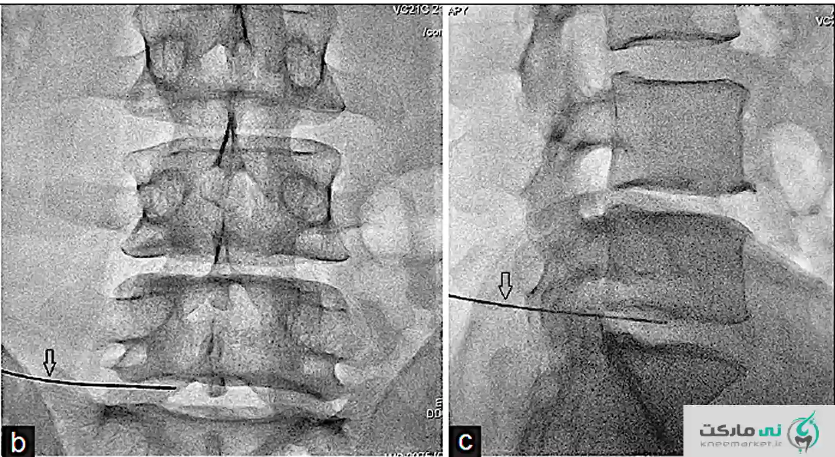 نحوه انجام اوزون تراپی دیسک کمر