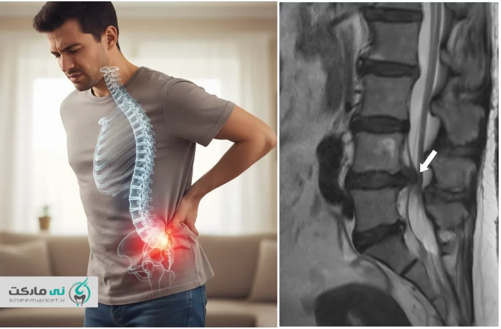 عکس پارگی دیسک کمر