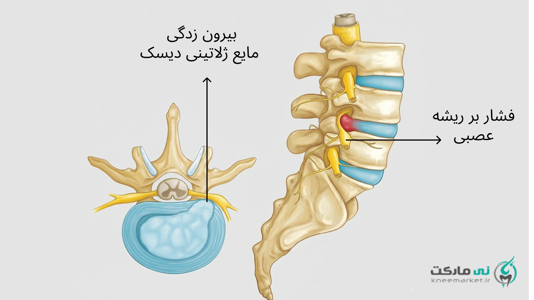 عکس بیرون زدگی دیسک کمر
