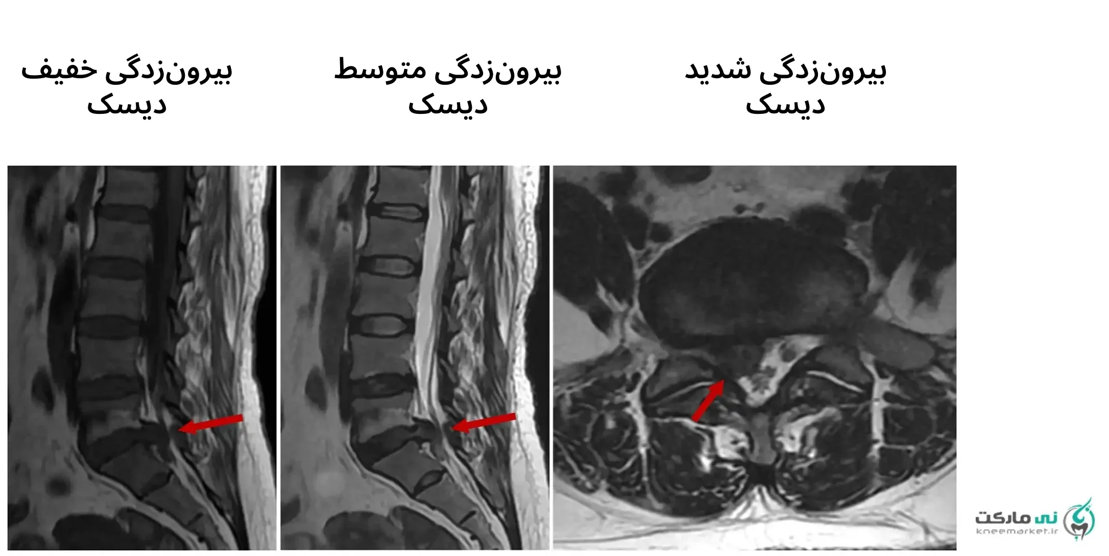 عکس ام آر آی بیرون زدگی دیسک