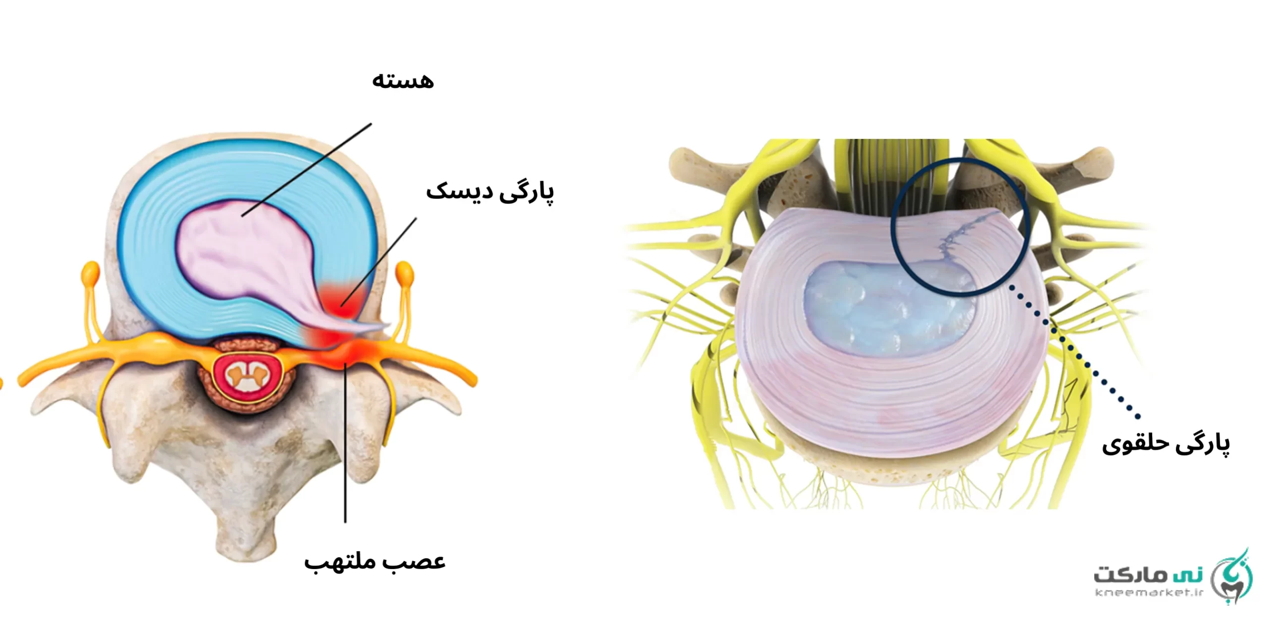 تصویر پارگی دیسک کمر