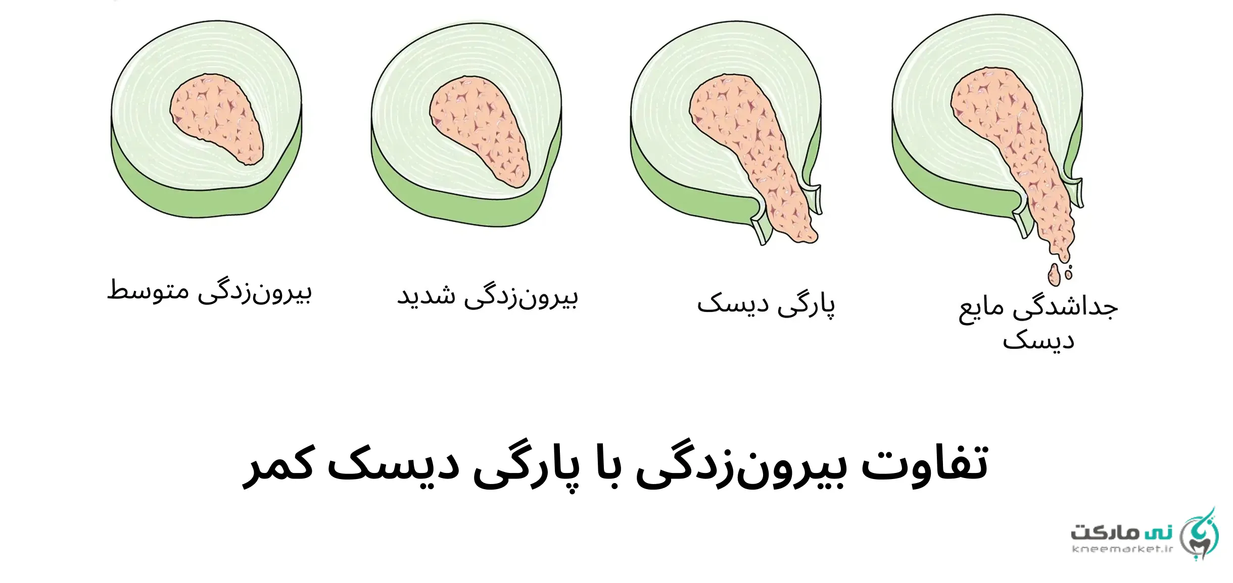 تفاوت پارگی و بیرون زدگی دیسک با عکس
