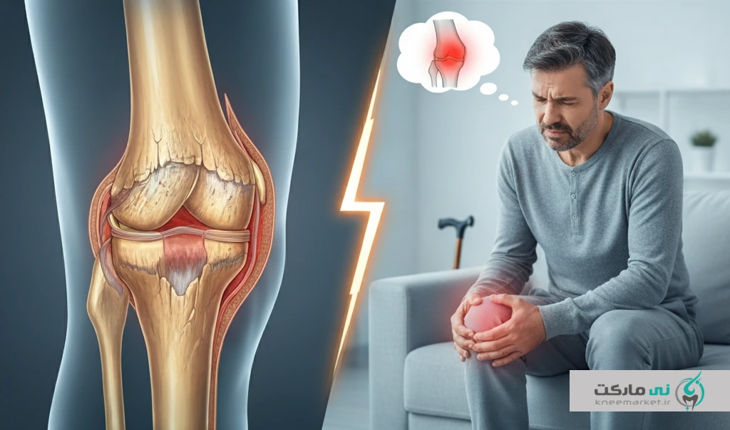 آرتروز زانو و شدت های مختلف