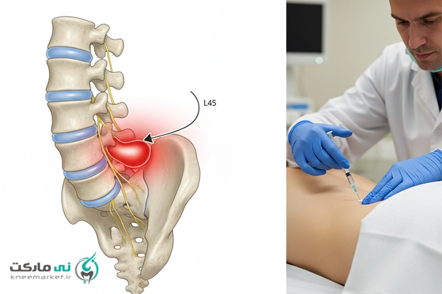 عکس درمان غیرجراحی پارگی دیسک کمر