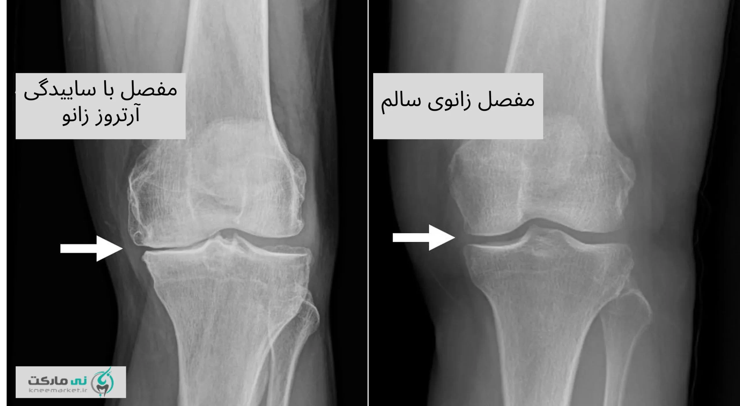 آرتروز زانو عکس ام آر آی