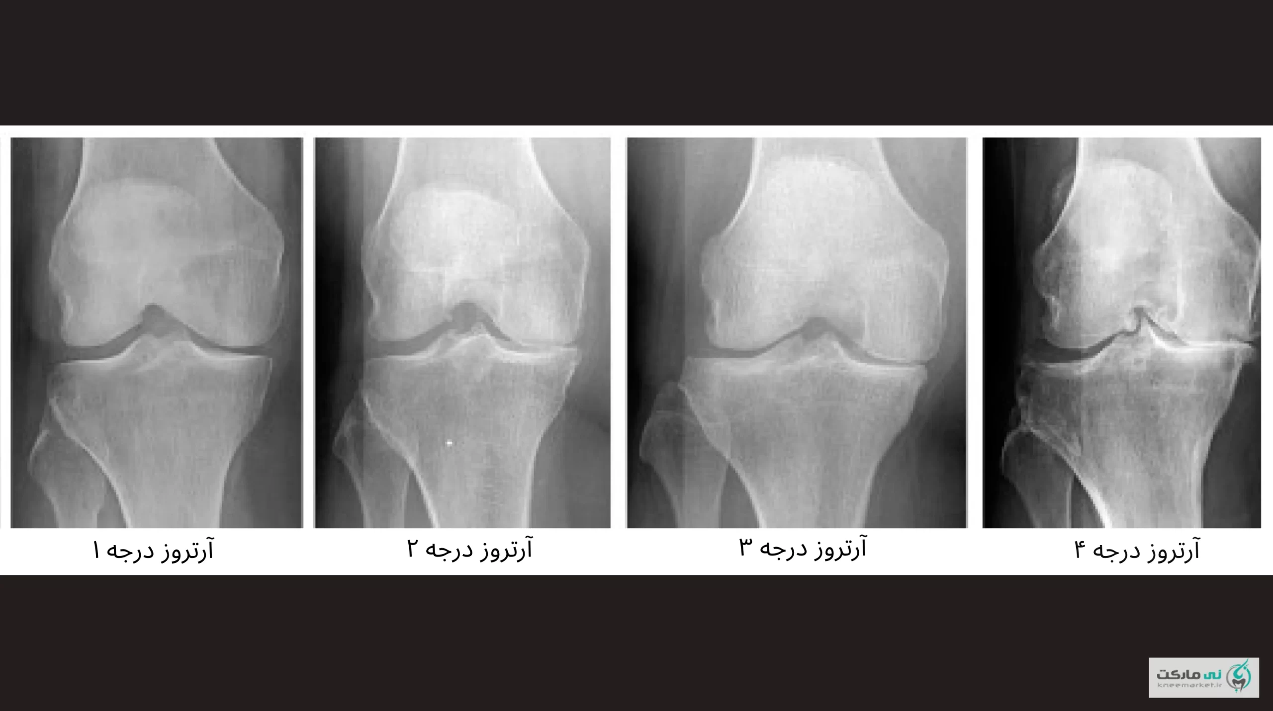 درجات آرتروز زانو