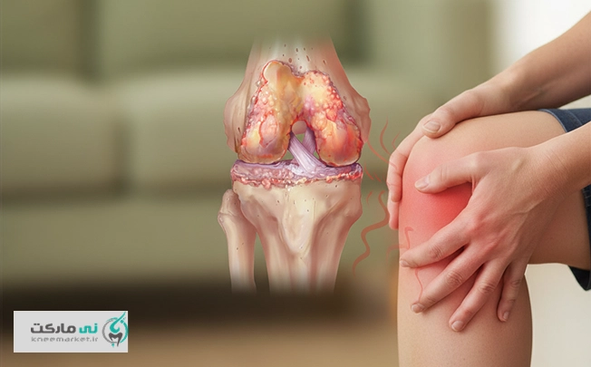 آرتروز زانو