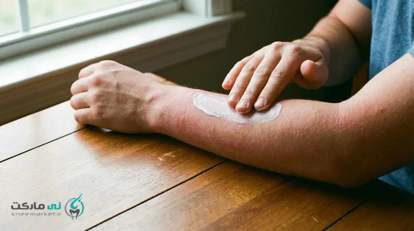 پماد بتامتازون برای زخم