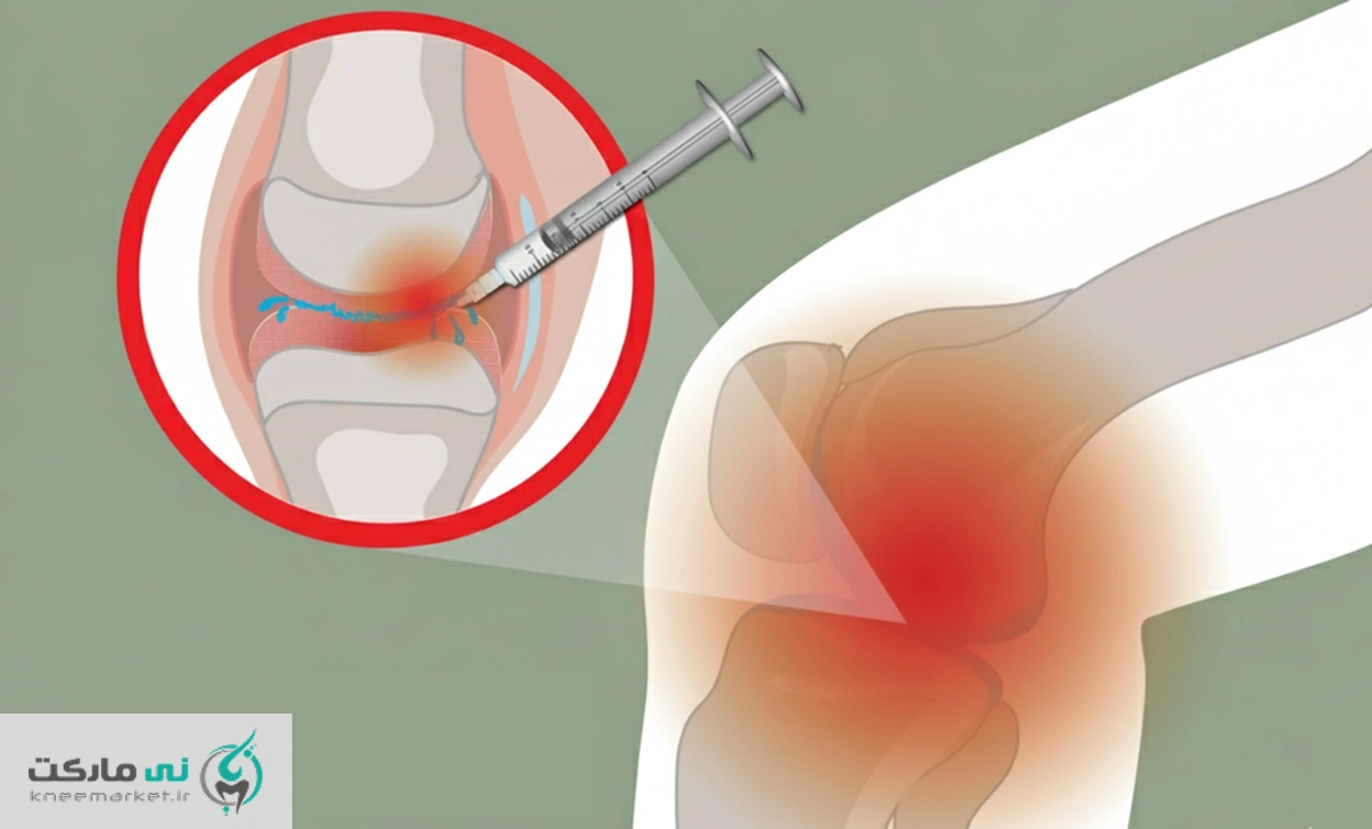 تزریق ژل به زانو