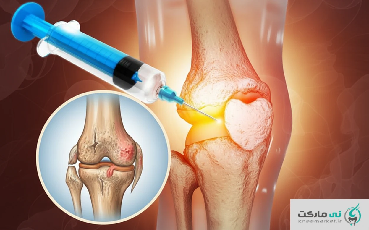 بهترین آمپول ترکیبی برای آرتروز زانو
