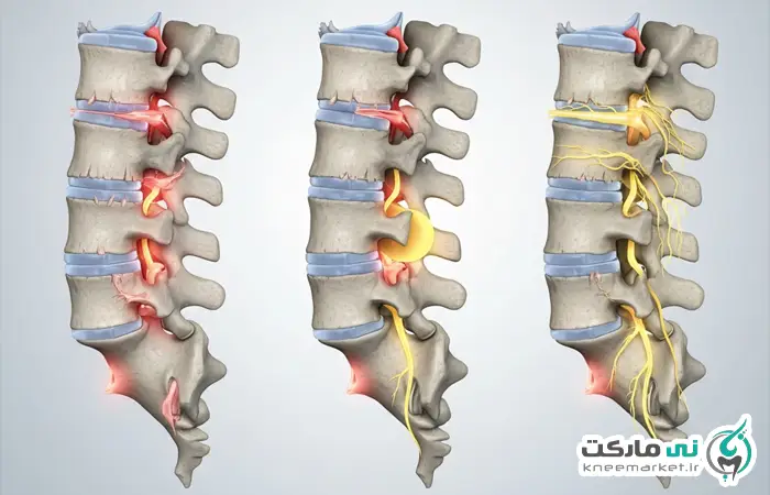 آرتروز کمر نی مارکت