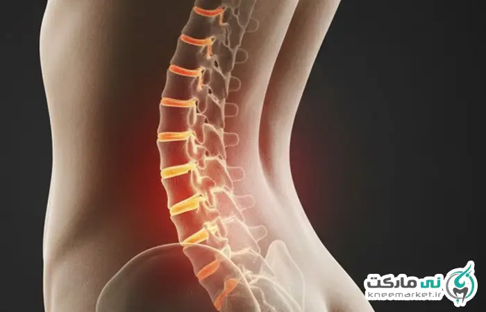 آرتروز کمر نی مارکت